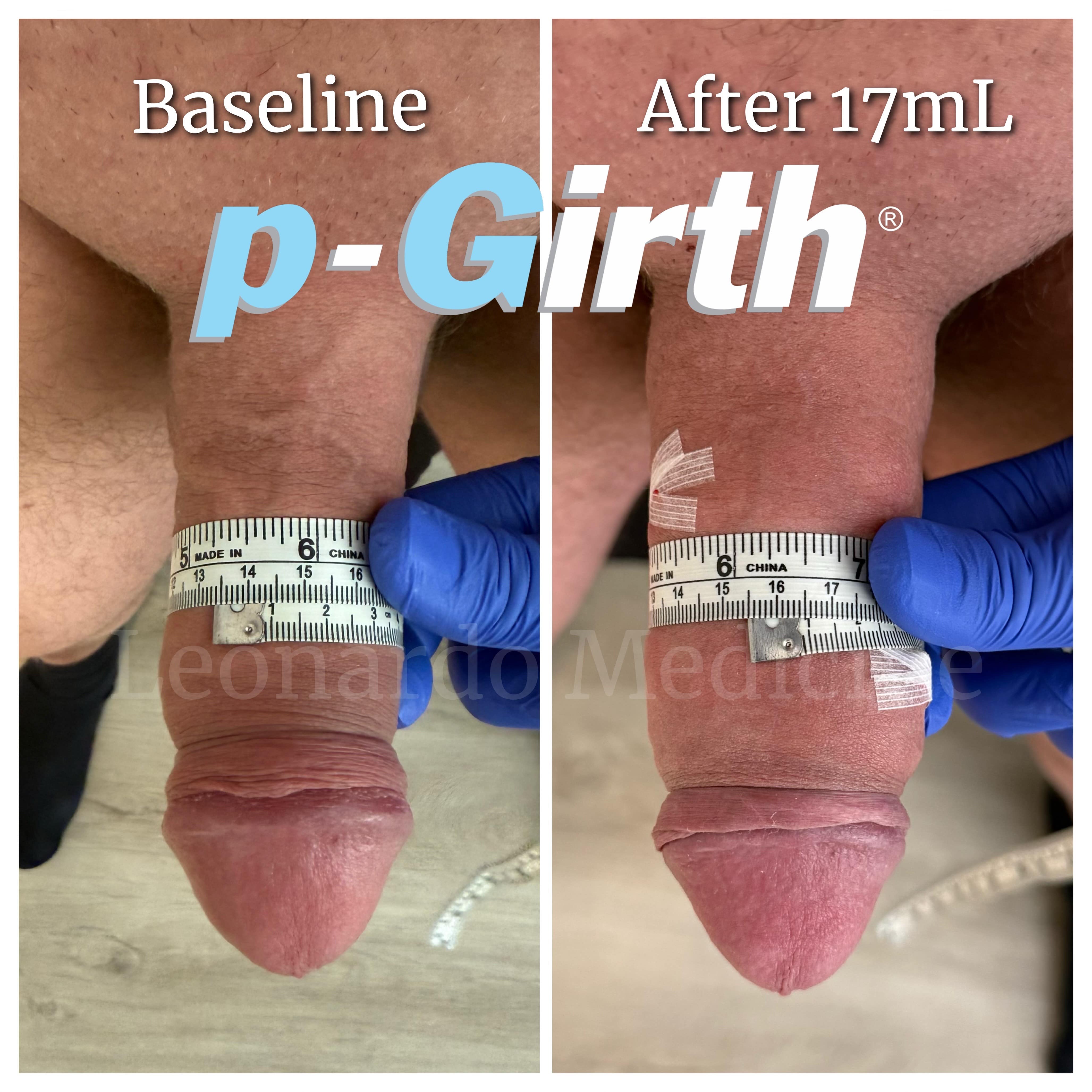 17ml2 min